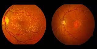 dry-macular-degeneration