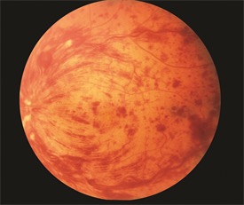 central-retinal-vein-occlusion