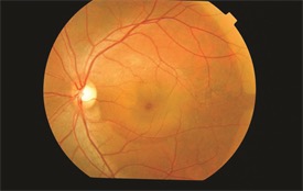 central-serous-retinopathy