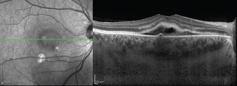 central-serous-retinopathy-oct