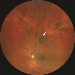 choroidal-nevus