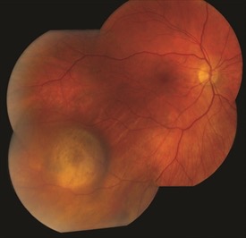 choroidal-melanoma