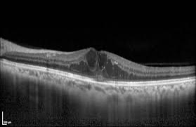 diabetic-macular-edema-oct