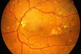 diabetic-retinopathy