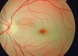 Retinal Artery Occlusion