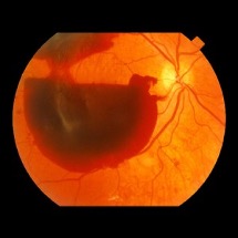 Vitreous Hemorrhage